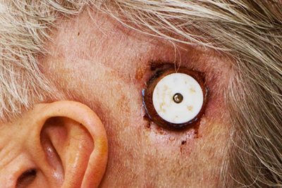 3 days after surgery