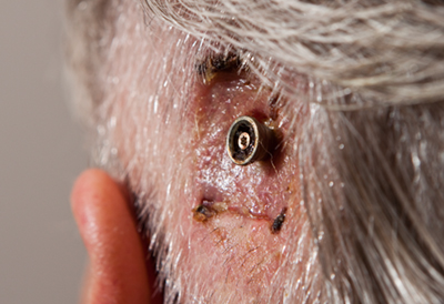 profile after 15 days