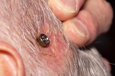 abutment is very small